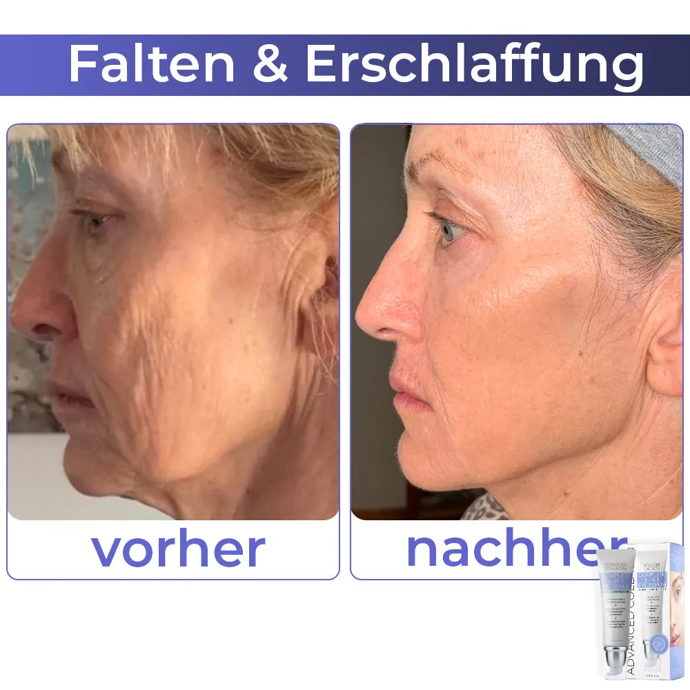 flysmus Fortgeschrittene Kollagen Vollstndig Augencreme
