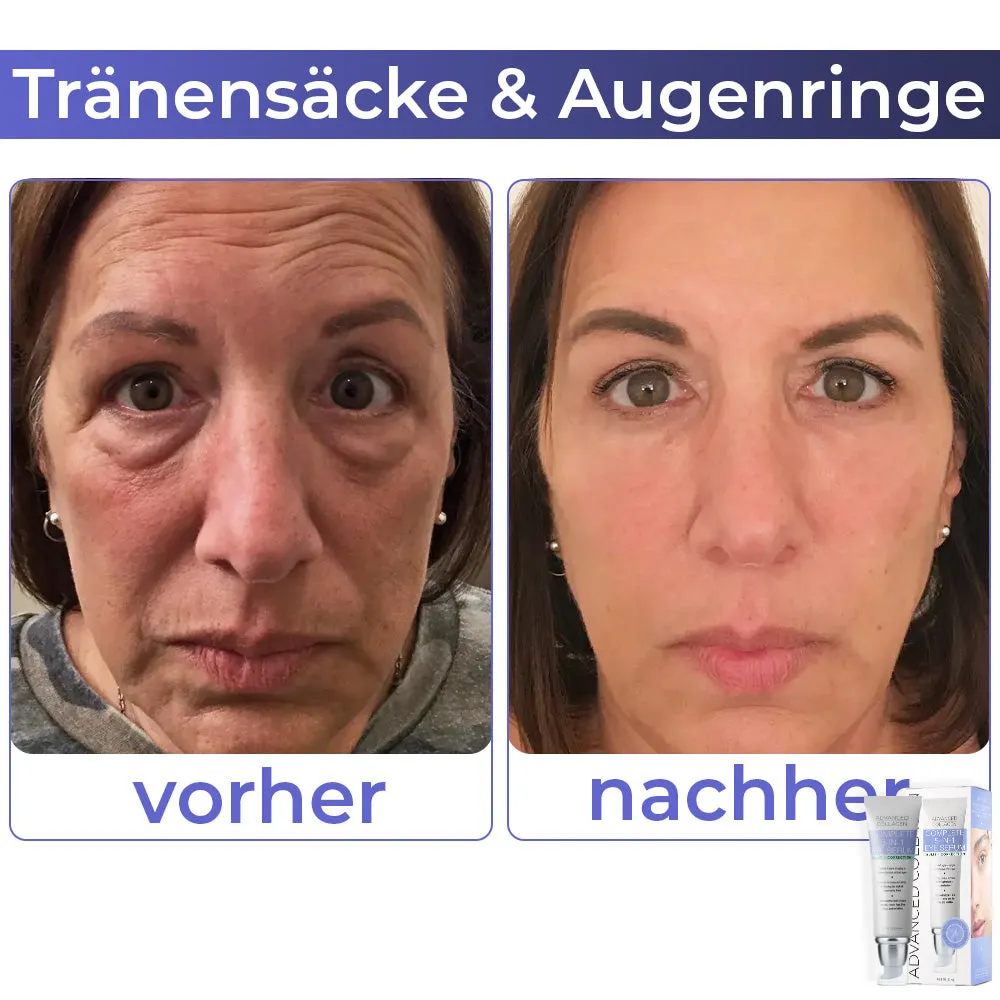 flysmus Fortgeschrittene Kollagen Vollstndig Augencreme